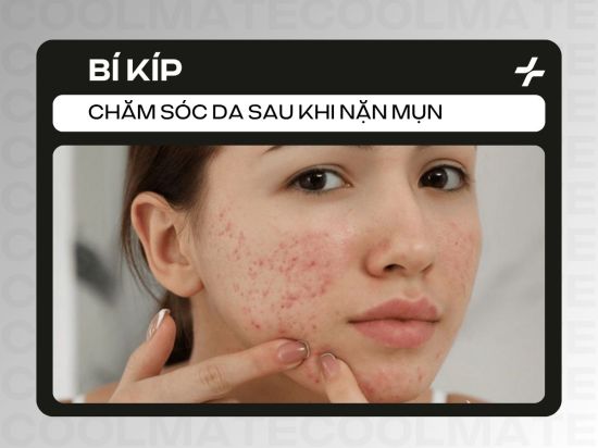 Chăm sóc da sau khi nặn mụn: Bí kíp phục hồi, ngừa thâm sẹo
